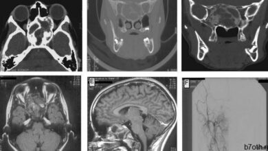 العظام المغناطيسية في البشر