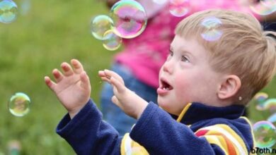 متلازمة داون