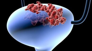 سرطان المثانة